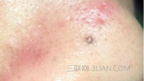 挤黑头发炎了怎么办