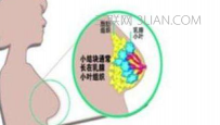 小叶增生是什么