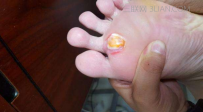 如何治疗鸡眼