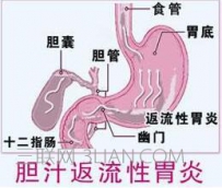 胆汁反流性胃炎生活要注意些什么