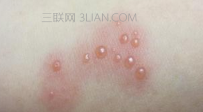 疥疮早期有哪些症状如何治疗