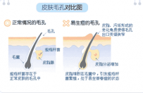 快速去痘痘产品 如何一天之内消除痘痘