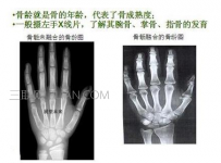 如何测骨龄