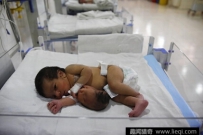 震惊！一女子产下罕见双头女婴