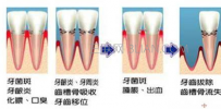 牙周炎日常要如何保健