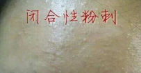 闭口粉刺可以挤吗