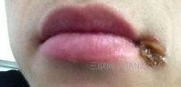 烂嘴角要怎么治