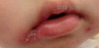 嘴角起泡怎么办