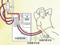 透析是什么