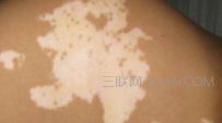 白癜风传染吗