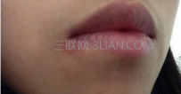 嘴角起泡怎么快速消除