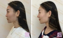 隆鼻对比照 看完震惊了