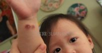 痱子和湿疹有什么区别