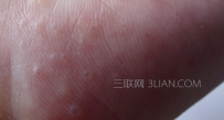 手上起小水泡痒如何是好