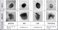 黑色素瘤和痣的区别