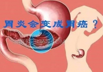 胃炎会变成胃癌吗