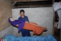 印尼女子患怪病 身体僵硬如木板