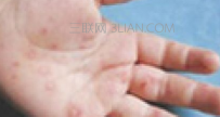 疱疹是怎么引起的？疱疹最快的治疗方法