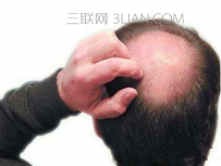 掉发严重是什么原因