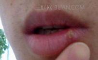 嘴角起泡是怎么回事