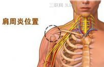 如何治疗肩周炎