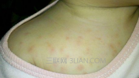 痱子怎么治疗